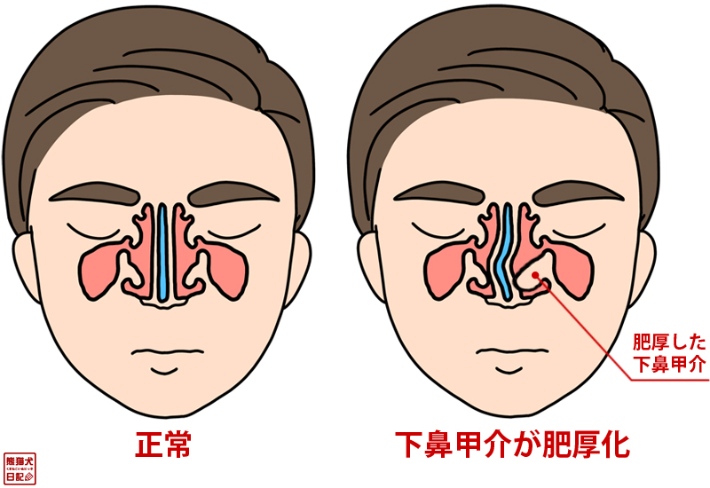 肥厚性鼻炎